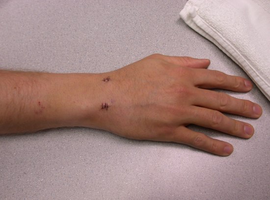 Wrist Surgery
